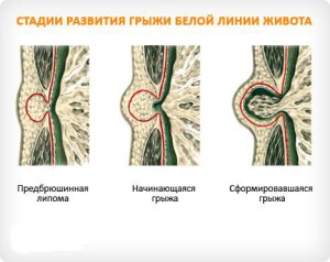 Виды грыж