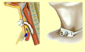 Установленная трахеостома