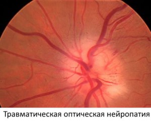 Травматичесая атрофия зрительного нерва