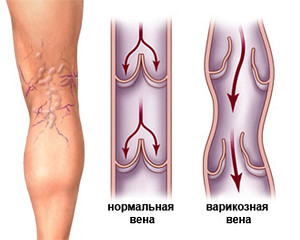 Варикозное  расширение вен