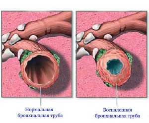 Бронхи здоровые и больные