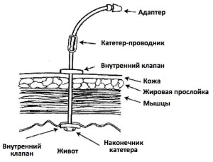 Установленная гастростома