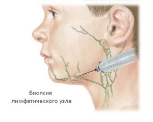 Биопсия лимфоузла