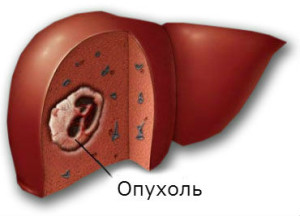 Опухоль печени