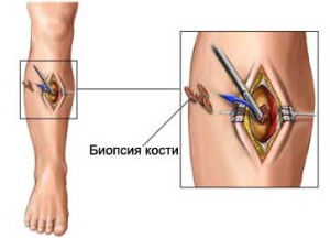 Биопсия