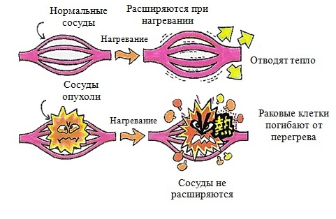 Принцип действия гипертермии