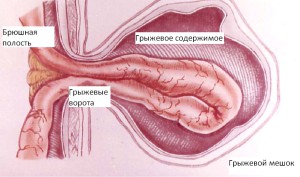 Структура пупочной грыжи