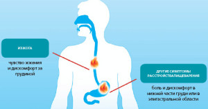 Изжога симтомы
