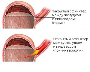 Проявление изжоги