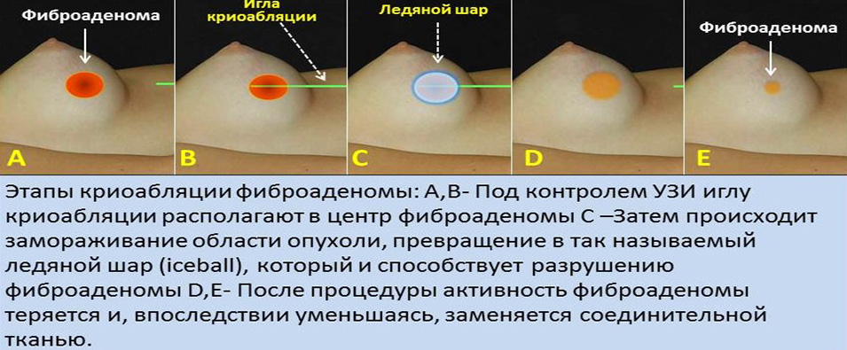 Криоабляция молочных желез