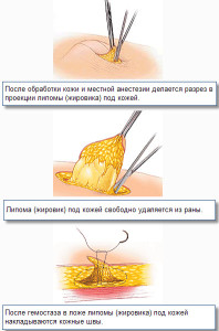 Удаление липомы