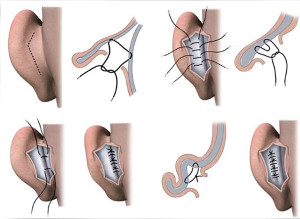 Хирургическая коррекция лопоухости