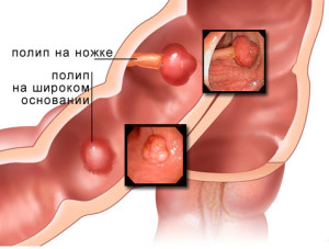 Полипы в толстом кишечнике