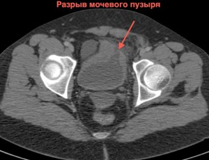 Разрыв мочевого пузыря