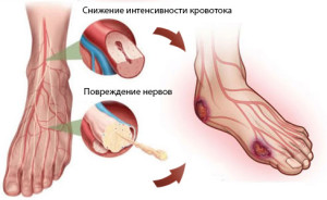 Риски при диабетической стопе