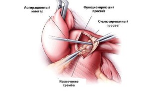 Удаление тромба хирургически