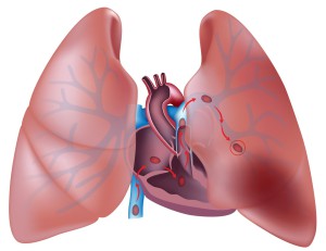 Тромбоз легочной артерии