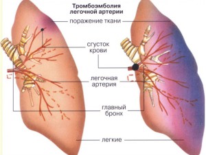 Тромбоз легочной артерии