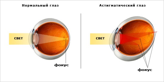 Характеристики астигматизма