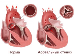 Аортальный стеноз