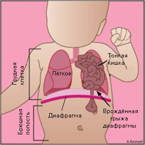 Грыжа диафрагмы