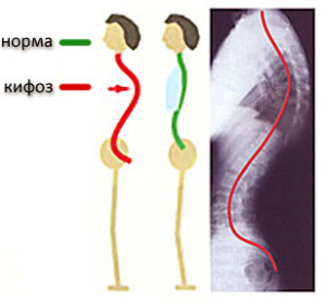Признаки кифоза