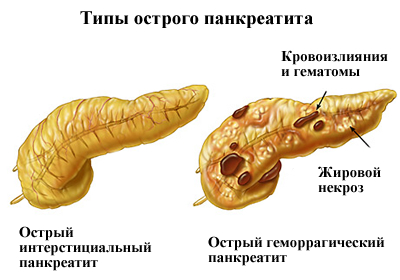 Эрхпг при остром панкреатите thumbnail
