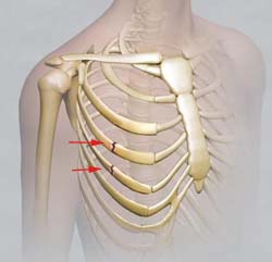 Перелом ребер