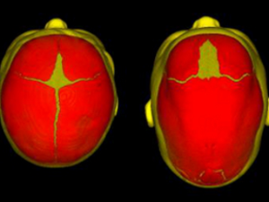 Краниосиностоз