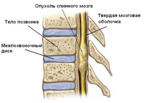 Опухоль спинного мозга