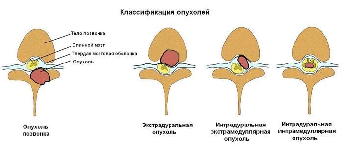 Разновидности опухолей