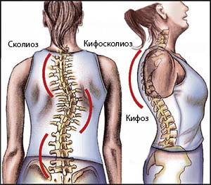 Признаки кифосколиоза