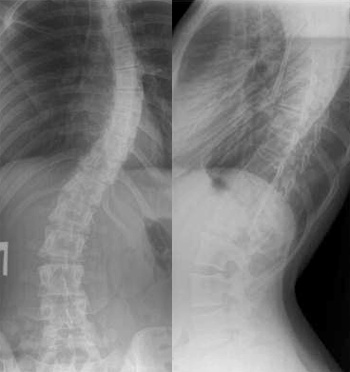 Кифосколиоз - симптомы, диагностика и лечение