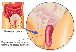 Паховая грыжа