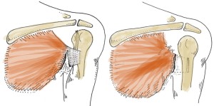 Разрыв грудной мышцы