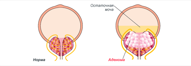 Опухоль простаты