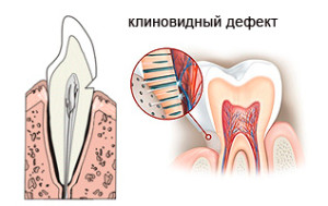 Симптомы клиновидного дефекта зубов