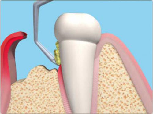 Открытый и закрытый кюретаж пародонтальных карманов