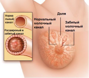 Мастит