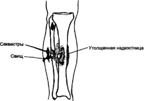 Поражение кости