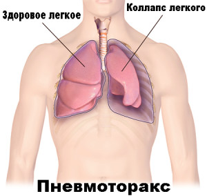 Пневмоторакс