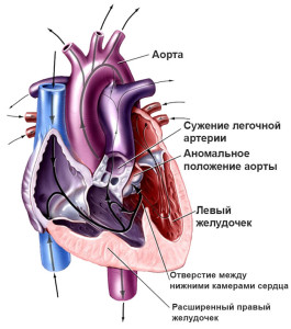 Тетрада Фалло