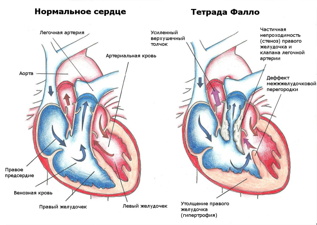 Здоровое и больное сердце