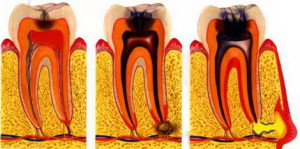 Зубная боль при кариесе