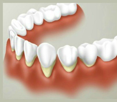 Причины и симптомы рецессии десны