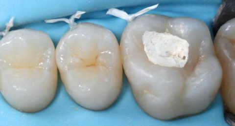 Временные зубные пломбы