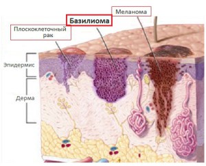 Структура базалиомы