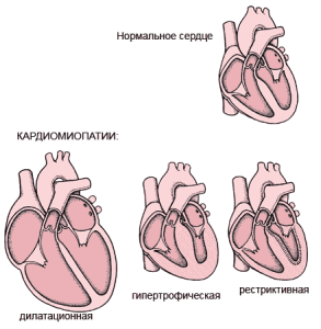Виды кардиомиопатий