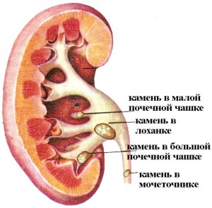 Камни в почечных лоханках