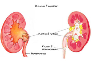 Камни в почках